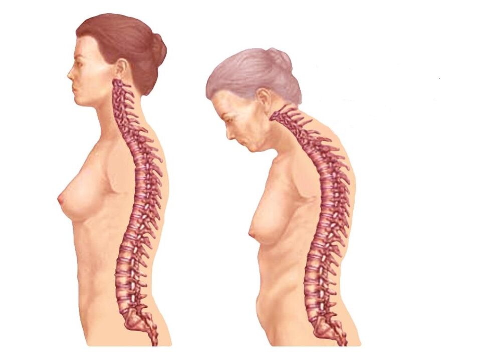 spine cuartha sláintiúil le osteochondrosis