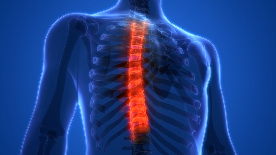 Osteochondrosis an spine chliabhraigh, arb iad is sainairíonna scrios na dioscaí intervertebral