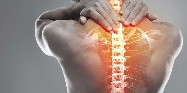 Roghanna leighis le haghaidh teiripe cheirbheacsach osteochondrosis ceirbheacs