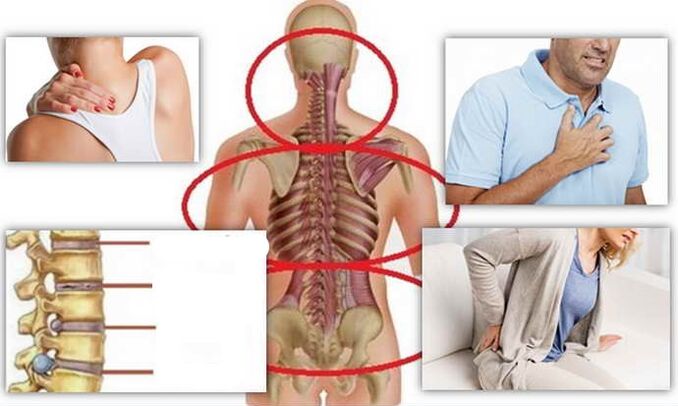 Áiteanna galair le haghaidh osteochondrosis