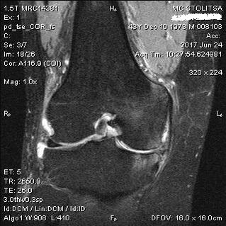 Osteoarthritis an chomhpháirteach glúine ar MRI