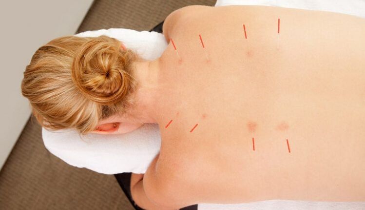 Acupuncture le haghaidh osteochondrosis thoracach, a bhfuil go leor buntáistí aige